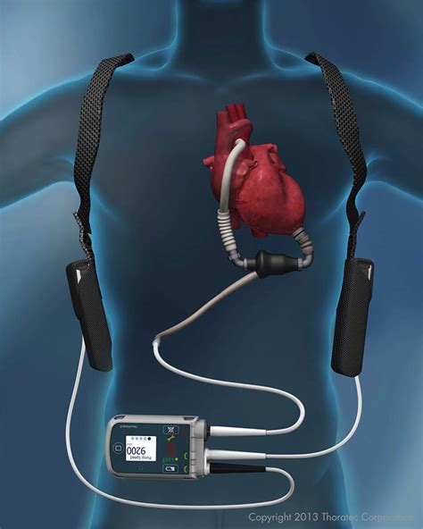 lv machine|external heart pump machine.